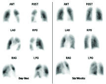 Lung Scan